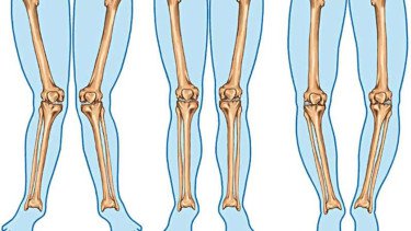 Jangan Sepelekan, Ini Komplikasi Kelainan Kaki O dan X Pada Anak Jika Tidak Ditangani
