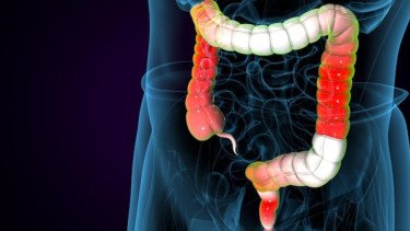 Kasus Radang Usus Meningkat di Indonesia, Banyak Pasien Terdiagnosis Fase Lanjut