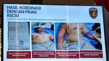 RSCM Ungkap Kondisi Terkini Andrie Yunus: Kerusakan Sel Punca Kornea Sekitar 40 Persen