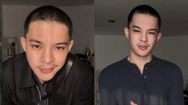Rey Mbayang Idap Autoimun Psoriasis, Penampilannya Berubah Drastis!