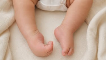 Ilustrasi kelainan kaki pada bayi