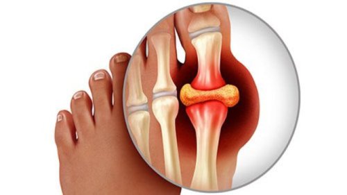 Top 7+ Obat Herbal Ampuh untuk Menurunkan Asam Urat Secara Alami dan Aman