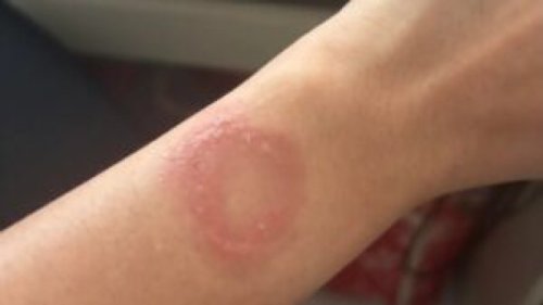 Apple Watch Overheat Hingga Picu Luka Bakar Permanen