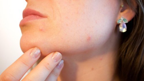 Ciri-Ciri Purging vs Breakout, Kandungan Skincare yang Sering Picu Purging, Kandungan Skincare yang Sering Picu Breakout, Apa yang Harus Dilakukan Kalau Mengalami Salah Satunya?, Kapan Harus Konsultasi ke Dokter?, Kenapa Skincare Bikin Purging dan Breakout?