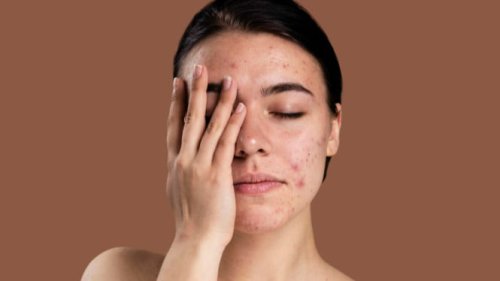 Top 7+ Kesalahan Fatal Saat Memakai Skincare yang Bikin Wajah Breakout