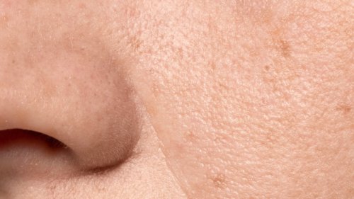 Pori-Pori Besar Bikin Risih? Ini Cara Mengecilkannya Menurut Ahli Dermatologi