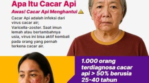 Hati-Hati Cacar Api di Area Wajah Bisa Sebabkan Gangguan Penglihatan