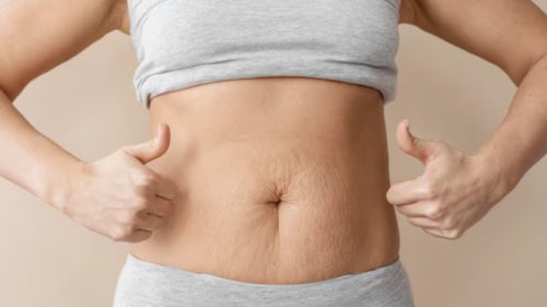 Top 6+ Tips Menghilangkan Stretch Mark dengan Cara Alami dan Aman, Simak Langkah-langkahnya!