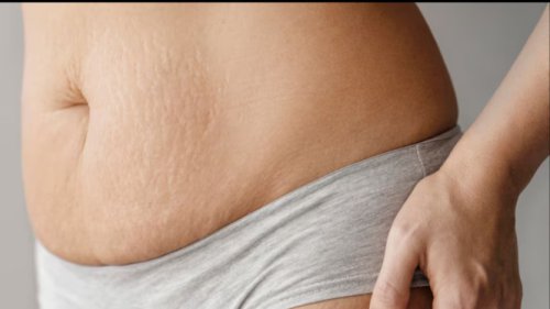 Tips Menyamarkan Stretch Mark agar Kulit Tampak Lebih Halus dan Cerah, Yuk Coba Cara Alaminya!