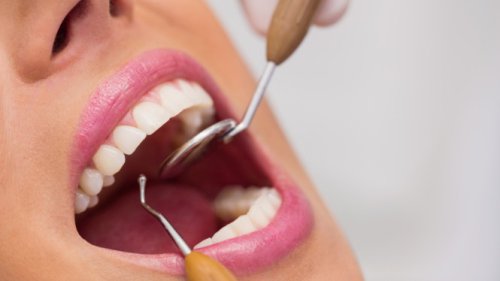 Top 5+ Cara Menghilangkan Karang Gigi dengan Bahan Alami dan Aman