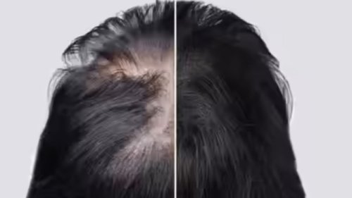 Top 6+ Ramuan Alami Efektif Atasi Rambut Rontok, Rangsang Pertumbuhan Lebih Cepat hingga Kurangi Kebotakan