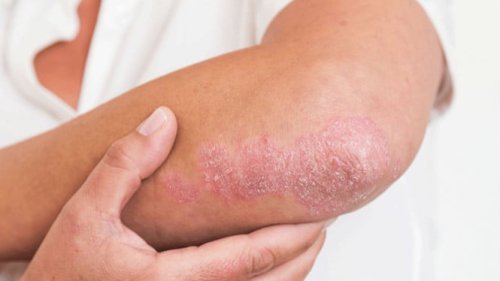 Top 7+ Rekomendasi Perawatan Alami Eksim: Aman untuk Kulit Sensitif dan Minim Efek Samping