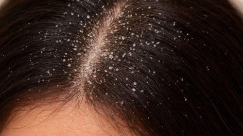 1. Minyak Kelapa, 2. Lidah Buaya, 3. Cuka Apel, 4. Baking Soda, 5. Teh Hijau, Tips Tambahan untuk Mencegah Ketombe, Top 5+ Tips Jitu Mengatasi Ketombe dengan Perawatan Sederhana di Rumah