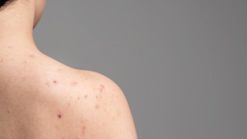 Jerawat di Punggung Bikin Nggak Percaya Diri? Ini Tips Skincare &amp; Gaya Hidup yang Bisa Bantu