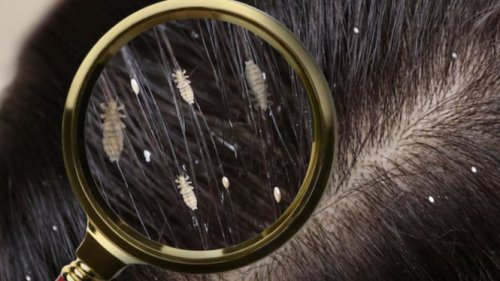 Top 7+ Cara Ampuh Mengatasi Kutu Rambut Hilang Sampai Telur-Telurnya