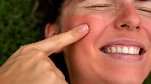 Jangan Cuek! Begini Ciri-Ciri Kulit Terkena Sunburn Akibat Paparan Sinar Matahari Berlebih