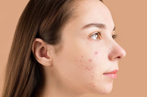 Top 7+ Cara Mengatasi Jerawat pada Kulit Kering