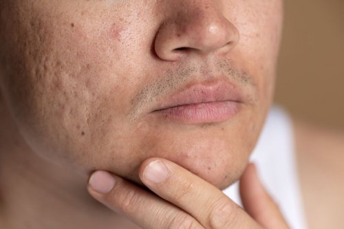 1. Bersikap baik pada kulit, 2. Sederhanakan rutinitas skincare, 3. Gunakan pembersih wajah yang lembut, 4. Tambahkan serum atau pelembab&nbsp;, 5. Pilih pelembab multifungsi, 6. Hindari eksfoliasi berlebihan, 7. Atasi peradangan, 8. Rawat kulit tubuh juga jangan hanya wajah, 9. Rawat diri dari dalam, 10. Mandi menggunakan air hangat, 11. Jangan lupa sunscreen, Top 11+ Cara Memperbaiki Skin Barrier yang Rusak Menurut Ahli