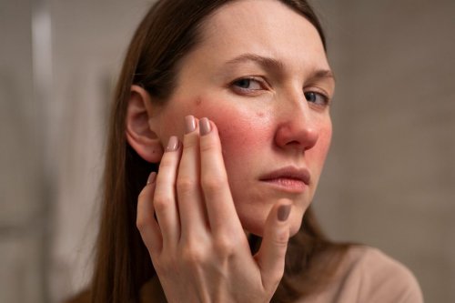 4 Tipe Penyakit Kulit Rosacea, Salah Satunya Rosacea Ocular