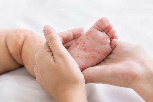 radang otak, komplikasi campak, virus campak, Campak pada anak, Paru dan Otak, Organ Tubuh yang Paling Diserang Campak