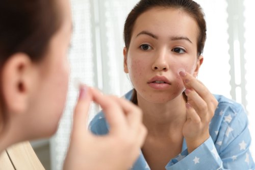acne patch, pimple patch, dermatolog, apakah pimple patch bisa menghilangkan bekas jerawat, kegunaan acne patch, manfaat acne patch, manfaat pimple patch, pimple patch untuk jerawat, Apakah Pimple Patch Bisa Menghilangkan Jerawat? Ini Jawaban Dokter