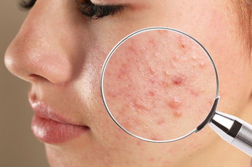 Risiko memencet jerawat, Apakah bopeng bisa hilang total?, Siapa yang lebih rentan mengalami bopeng?, Pentingnya mencegah jerawat meradang, Apakah Bopeng Bekas Jerawat Bisa Hilang? Ini Kata Dokter