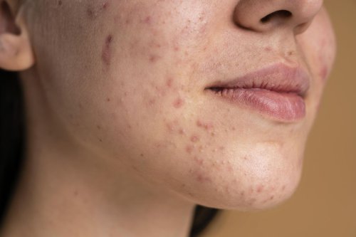 Cara Tepat Atasi Jerawat pada Kulit Sensitif Tanpa Takut Iritasi