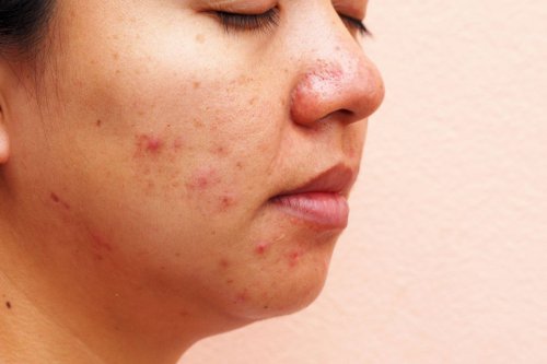 mitos jerawat, pengobatan jerawat, jerawat hormonal, skin barrier itu apa, dermatolog, jerawat pakai bawang putih, apakah jerawat pakai bahan keras, 3 Mitos Jerawat yang Masih Banyak Dipercaya Menurut Dokter