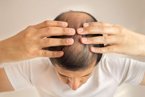 Beda Rambut Rontok dan Kebotakan pada Pria