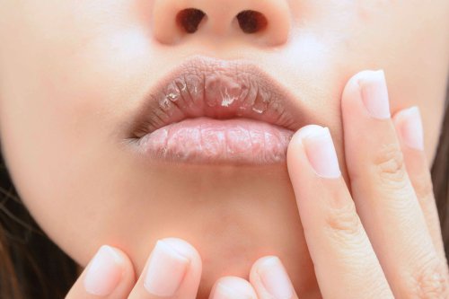 2 Cara Mengatasi Bibir Kering dan Pecah-pecah agar Tetap Lembap