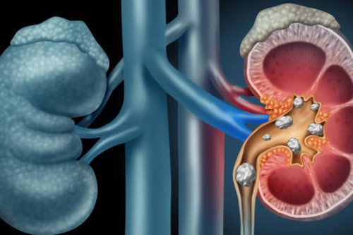 Top 5+ Jenis Makanan yang Dapat Sebabkan Batu Ginjal, Ini Kata Dokter