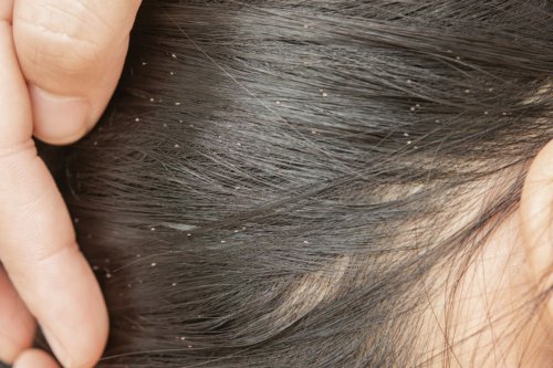 Kutu Rambut Bisa Turunkan Prestasi Sekolah Anak?