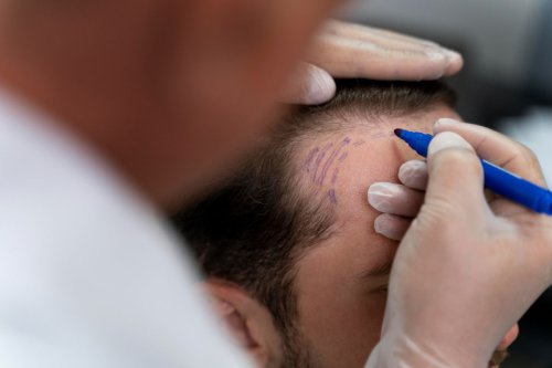 Top 5+ Pantangan Setelah Transplantasi Rambut, Minum Kopi dan Olahraga