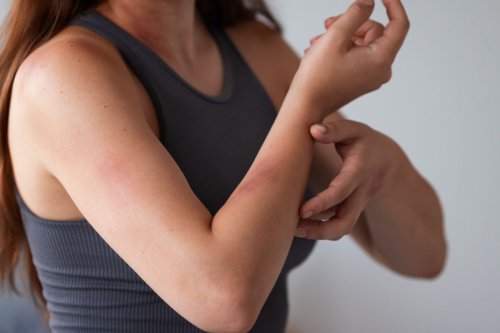 Perbedaan Kulit Sensitif dan Alergi, Jangan Sampai Salah!