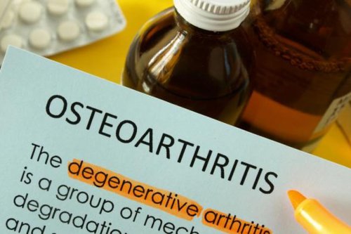 Berapa Lama Implan Lutut pada Pasien Osteoartritis Bisa Bertahan?