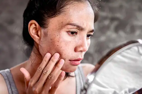 Cara Ampuh Mengatasi Flek Hitam, Dermatologis Ungkap Kunci Utamanya