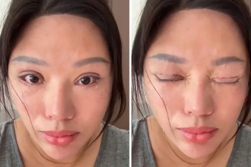 Operasi Kelopak Mata Gagal, Wanita Ini Tak Bisa Tidur Terpejam