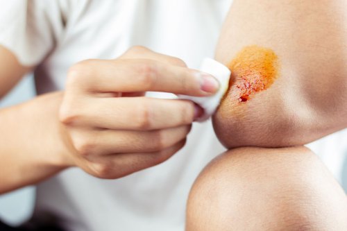 Kenali Jenis Luka Menurut Dokter, dari Superfisial hingga Kronis