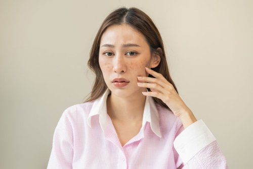 melasma, penyebab melasma, Melasma Tak Kenal Usia, Bukan Hanya Dialami Usia 40 Tahun ke Atas