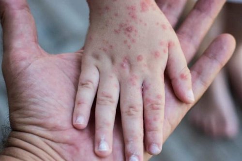 1 Orang di Riau Meninggal Diduga Cacar Monyet, 3 Lainnya Suspek