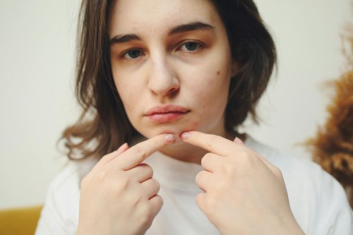 Top 7+ Urutan Skincare untuk Acne-Prone Skin Menurut Dokter Kulit
