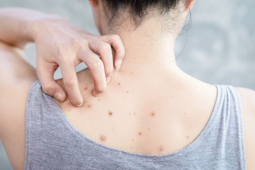 1. Produksi minyak berlebih, 2. Faktor genetik, 3. Penggunaan obat tertentu, 4. Hormonal, 5. Pakaian ketat, 6. Penumpukan sel kulit mati, 7. Bakteri, 8. Stres, Top 8+ Penyebab Jerawat di Punggung, Salah Satunya Pakaian Terlalu Ketat