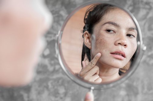 Flek Hitam Membandel? Kenali Jenis dan Penyebabnya
