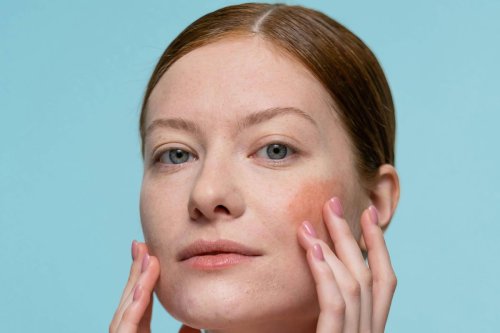Apa Itu Rosacea, Kondisi Peradangan Kulit yang Bikin Wajah Memerah?