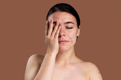 Jerawat Tak Kunjung Sembuh, Kapan Harus ke Dokter?