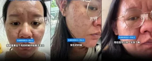 Viral Transformasi Wanita saat Hamil, Wajah Menggelap-Berkerut Bak Beda Orang
