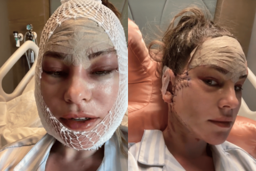 The decision to undergo a facelift., The procedure., The recovery., The commentary around her decision., 'I had a facelift at 37. People always have the same question.'