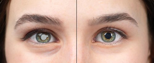 How to spot the early signs of a cataract