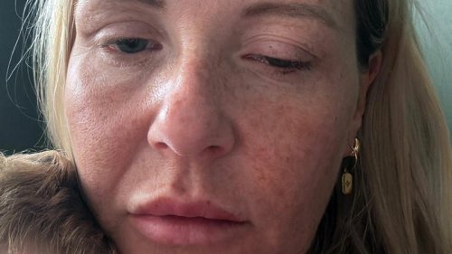 Toxic botox leaves patients frozen in deadly outbreak