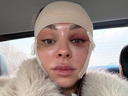 I traveled from the US to South Korea to get a facelift at 34. It boosted my confidence.